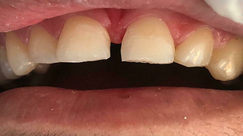 درمان دیاستم یا فاصله بین دندان ها