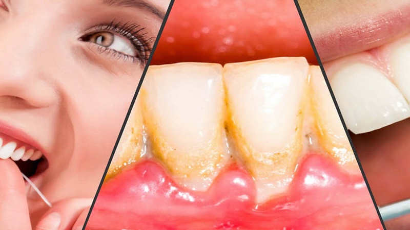 نخ دندان یا مسواک ؟