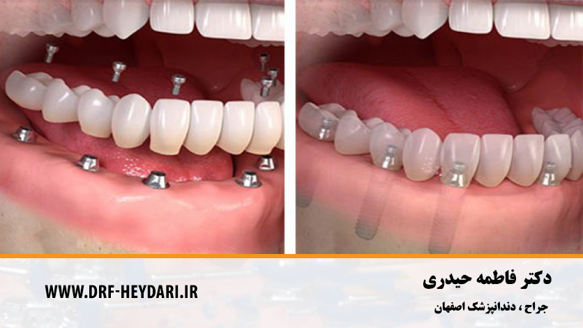 بهترین دندانپزشک اصفهان