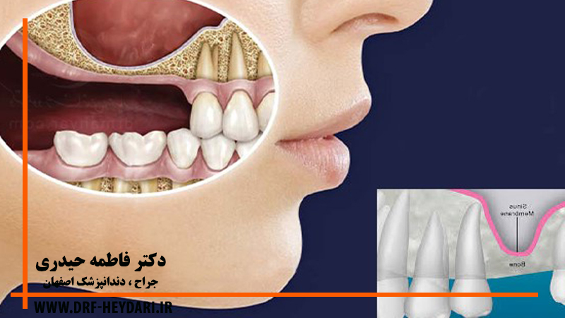 لیفت سینوس
