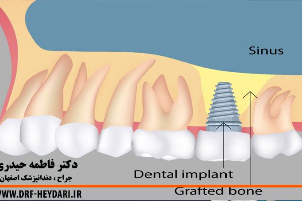 جراحی لیفت سینوس