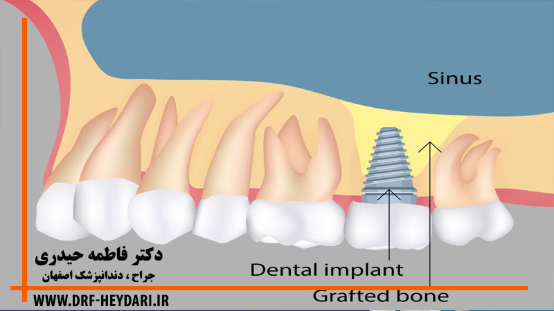 جراحی لیفت سینوس