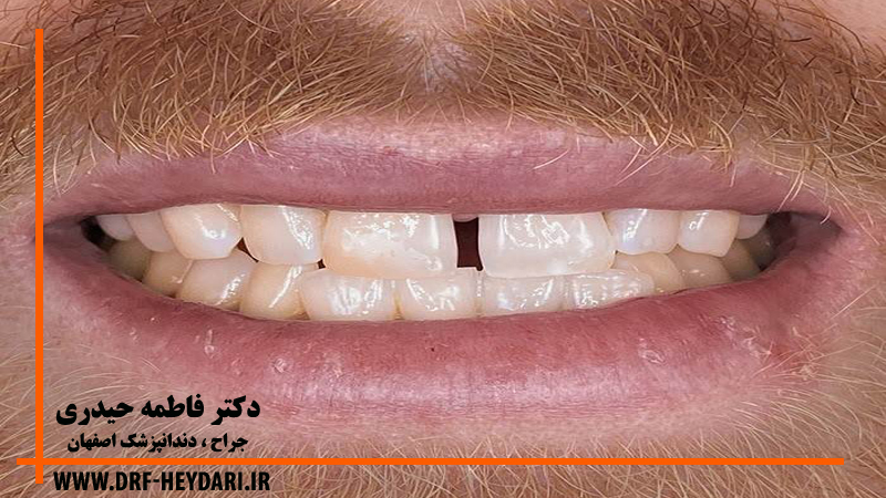 برطرف کردن دیاستم