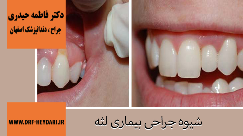 شیوه جراحی بیماری لثه