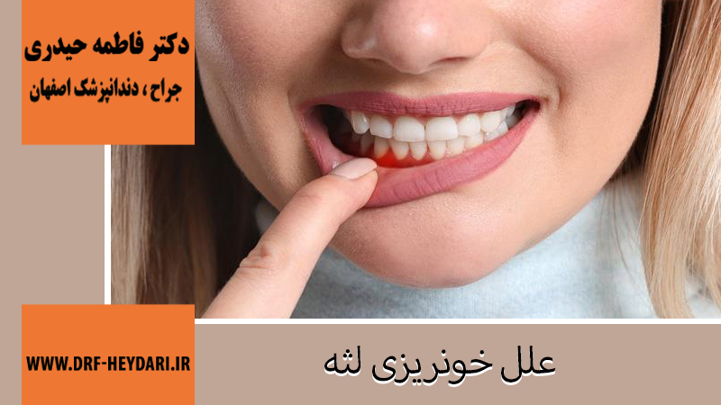 علل خونریزی لثه
