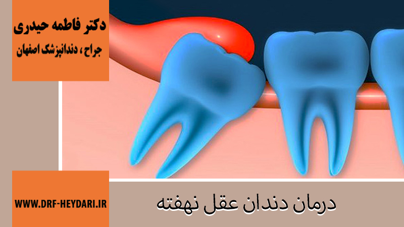 درمان دندان عقل نهفته