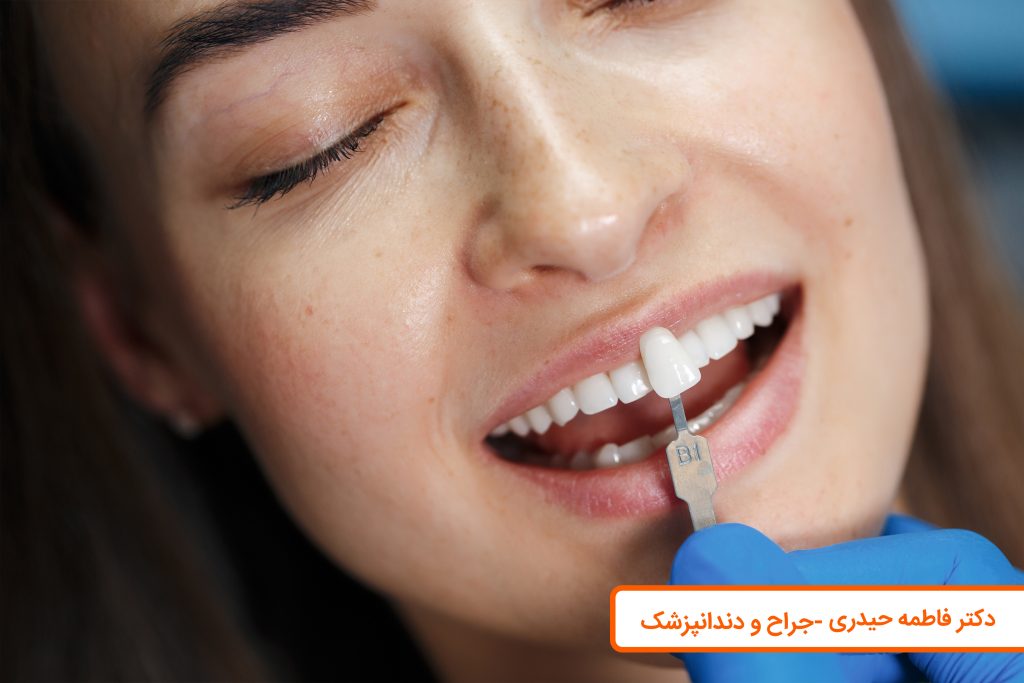 ونیر کامپوزیت دندان اصفهان