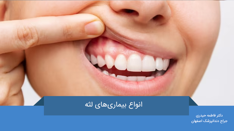 بیماری‌های لثه
