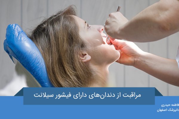 فیشور سیلانت