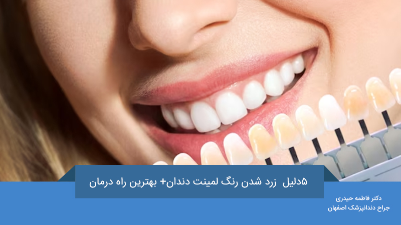 لمینت دندان