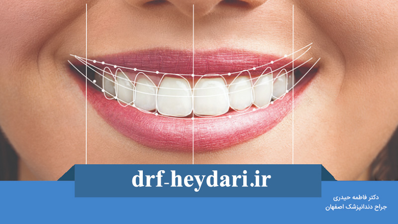 طراحی لبخند چیست؟