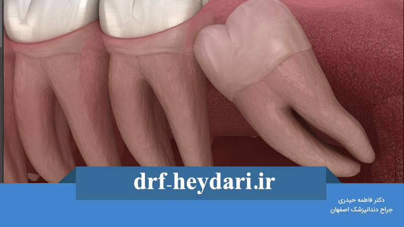مشکلاتی که دندان عقل ایجاد میکند