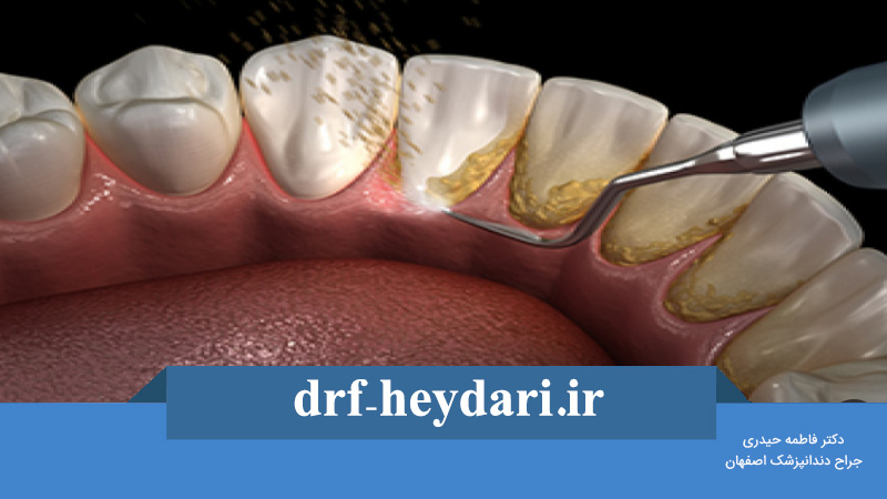 جرمگیری دندان ضرر دارد