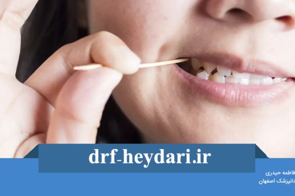 گیر غذایی بعد از عصب کشی