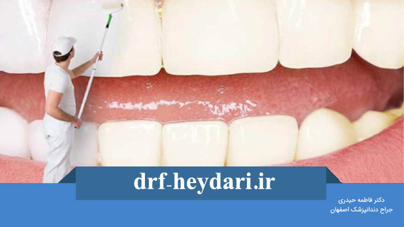 کیت بلیچینگ چیست؟