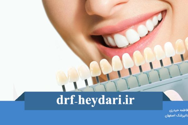 کاشت لمینت دندان نوجوان