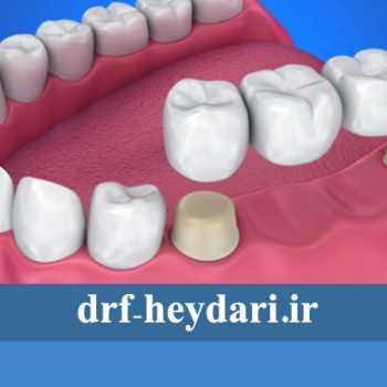 کاشت دندان به روش بریج برای کودکان