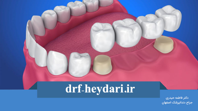 کاشت دندان به روش بریج برای کودکان