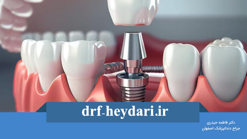پیچ ایمپلنت