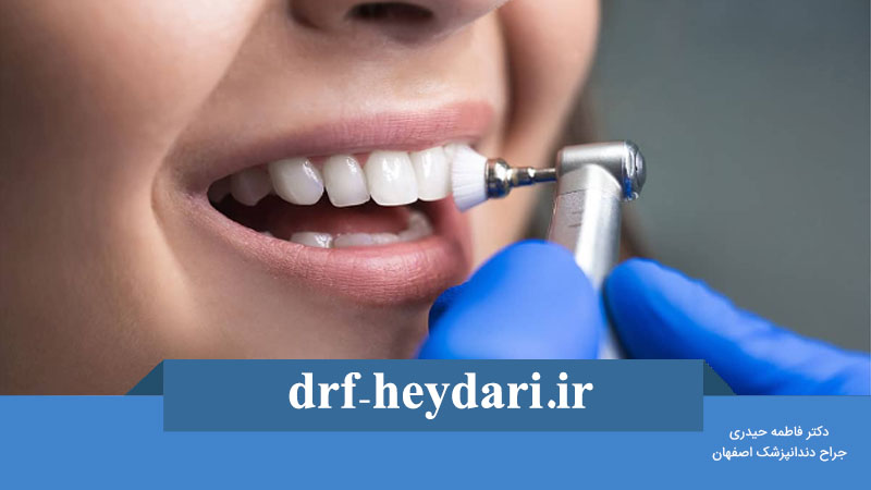 پولیش لمینت دندان