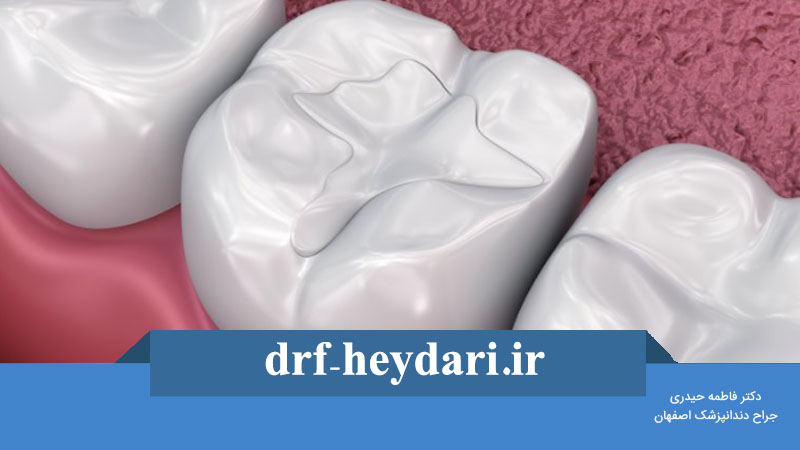 پر کردن سطحی دندان