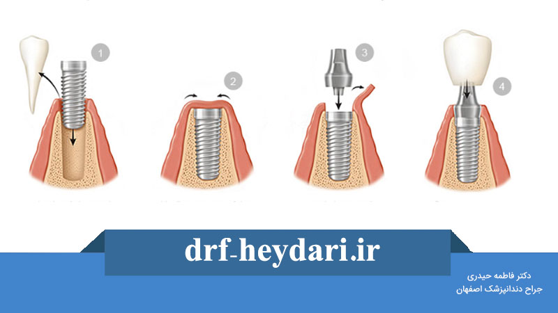 پروسه ایمپلنت دندان