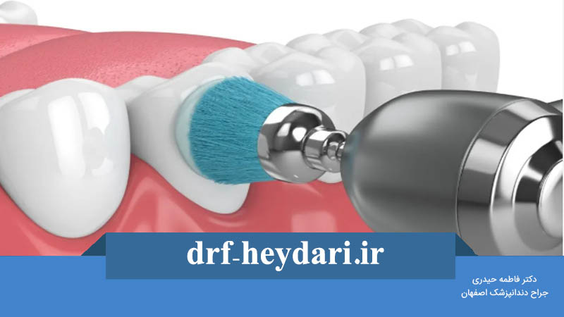 پالیش کامپوزیت چیست