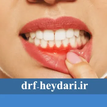 علائم و درمان آبسه دندان