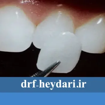 مدت زمان ماندگاری لمینیت دندان