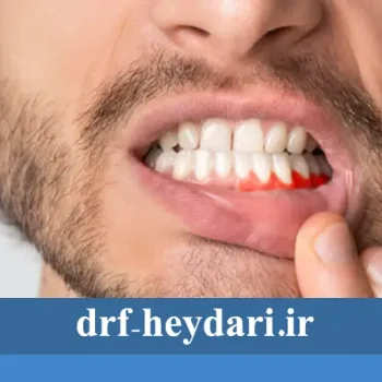 مراقبت‌های بعد از جراحی لثه