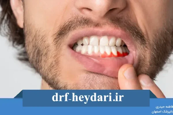 مراقبت‌های بعد از جراحی لثه