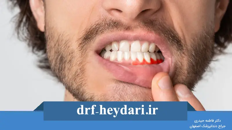 مراقبت‌های بعد از جراحی لثه