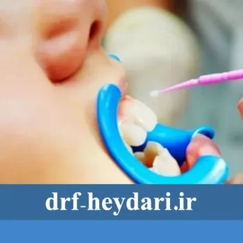 نقش فلورایدتراپی در سلامت دندان کودکان