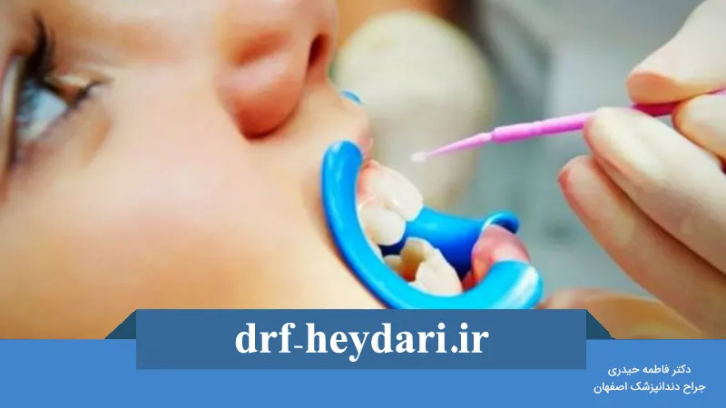 نقش فلورایدتراپی در سلامت دندان کودکان