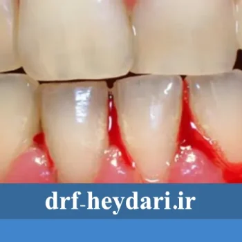 تفاوت بین ژنژیویت و پریودنتیت