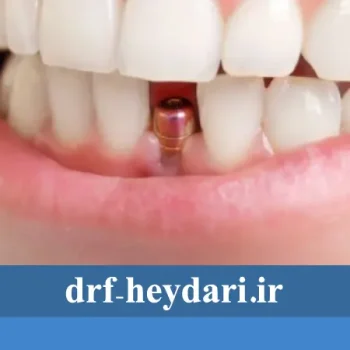 مراقبت‌های بعد از کاشت ایمپلنت