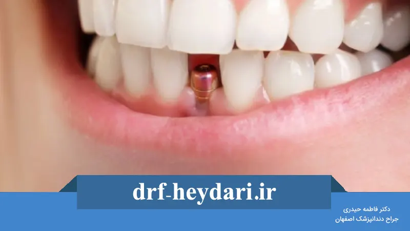 مراقبت‌های بعد از کاشت ایمپلنت