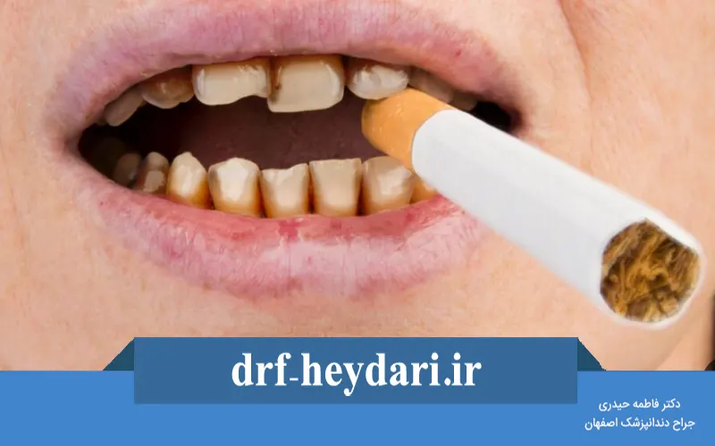 تأثیر سیگار بر بیماری‌های لثه