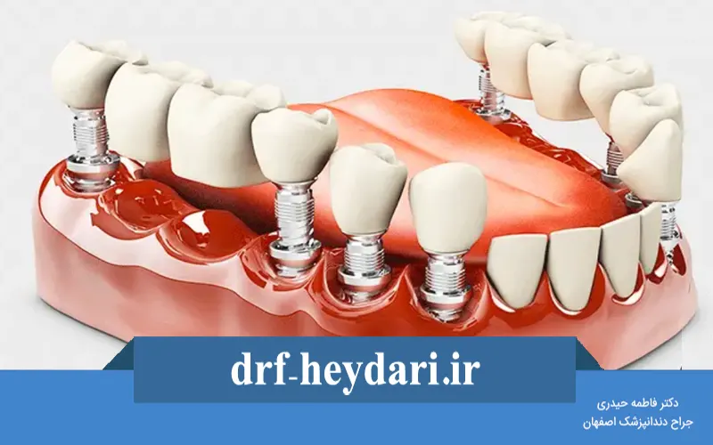 تفاوت پروتز ثابت و متحرک