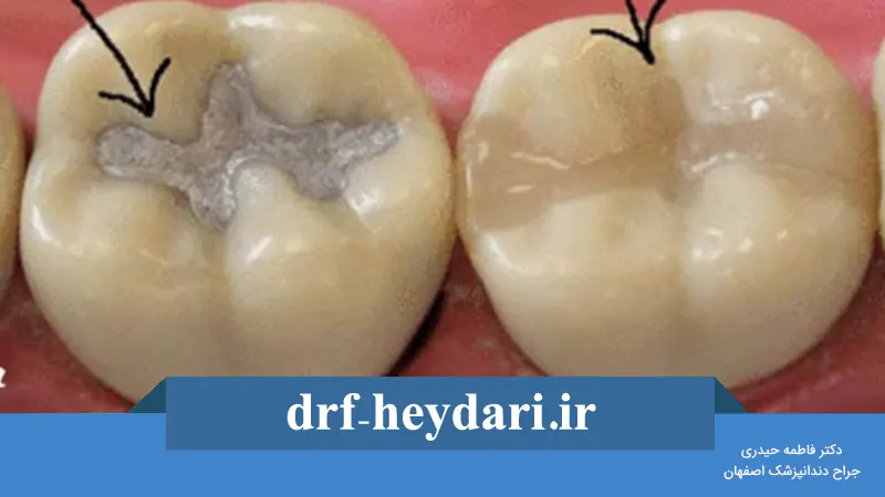 تفاوت بین پر کردن دندان با آمالگام