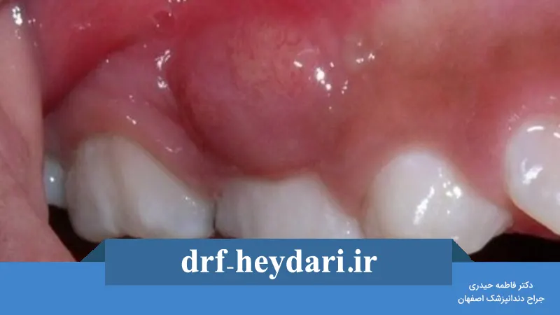 درمان التهاب لثه چگونه است؟