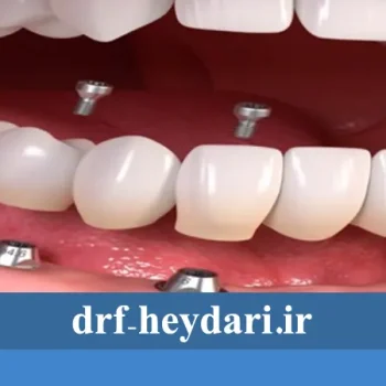 مزایا و معایب ایمپلنت دندانی