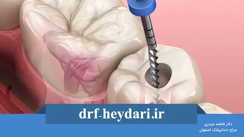 مراحل درمان ریشه دندان