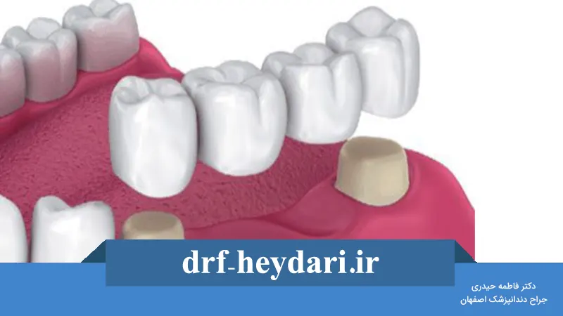 پروتز دندانی چیست و چه انواعی دارد