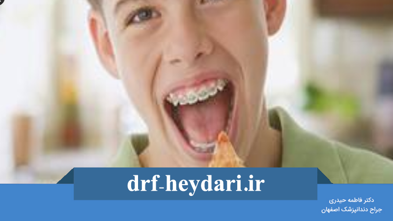 مراقبتهای غذایی در طول ارتودنسی