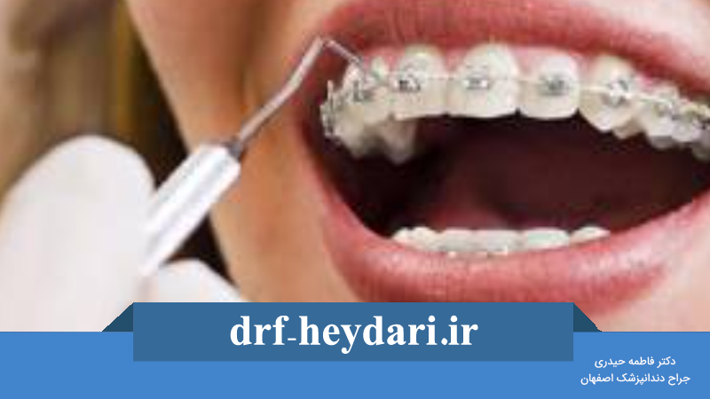 درمان فاصله بین دندانها با ارتودنسی