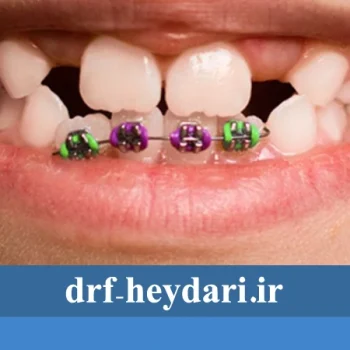 سن مناسب برای شروع ارتودنسی در کودکان