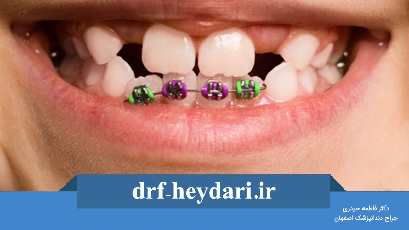 سن مناسب برای شروع ارتودنسی در کودکان