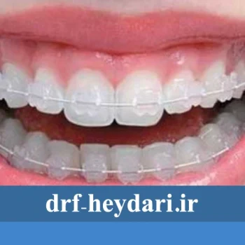 غذا های مناسب در طول ارتودنسی