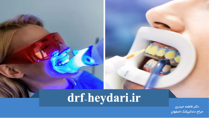 بلیچینگ دندان